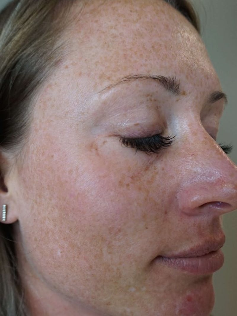 Halo™ Laser Skin Resurfacing Before & After Gallery - Patient 55455569 - Image 1