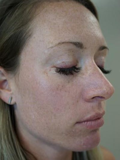 Halo™ Laser Skin Resurfacing Before & After Gallery - Patient 55455569 - Image 2