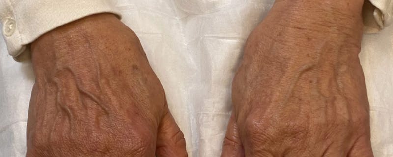 Hand Rejuvenation Before & After Gallery - Patient 55455584 - Image 1