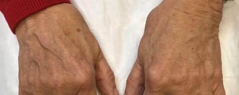Hand Rejuvenation Before & After Gallery - Patient 55455584 - Image 2