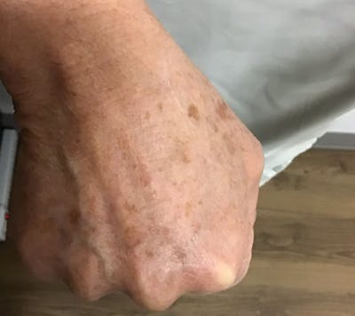 Hand Rejuvenation Before & After Gallery - Patient 55455585 - Image 1