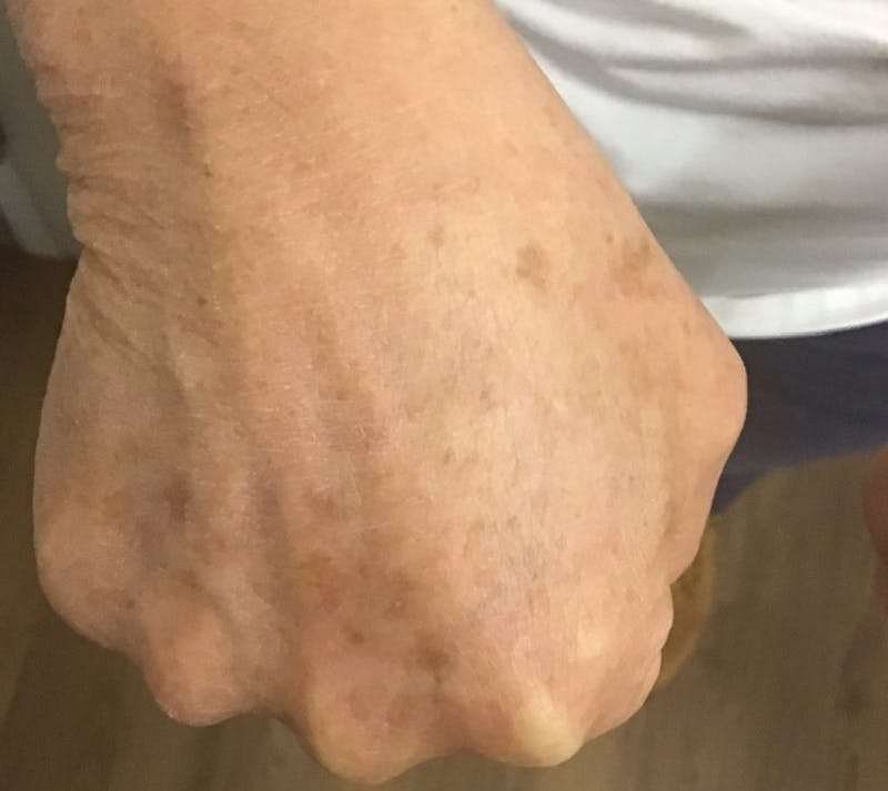 Hand Rejuvenation Before & After Gallery - Patient 55455585 - Image 2