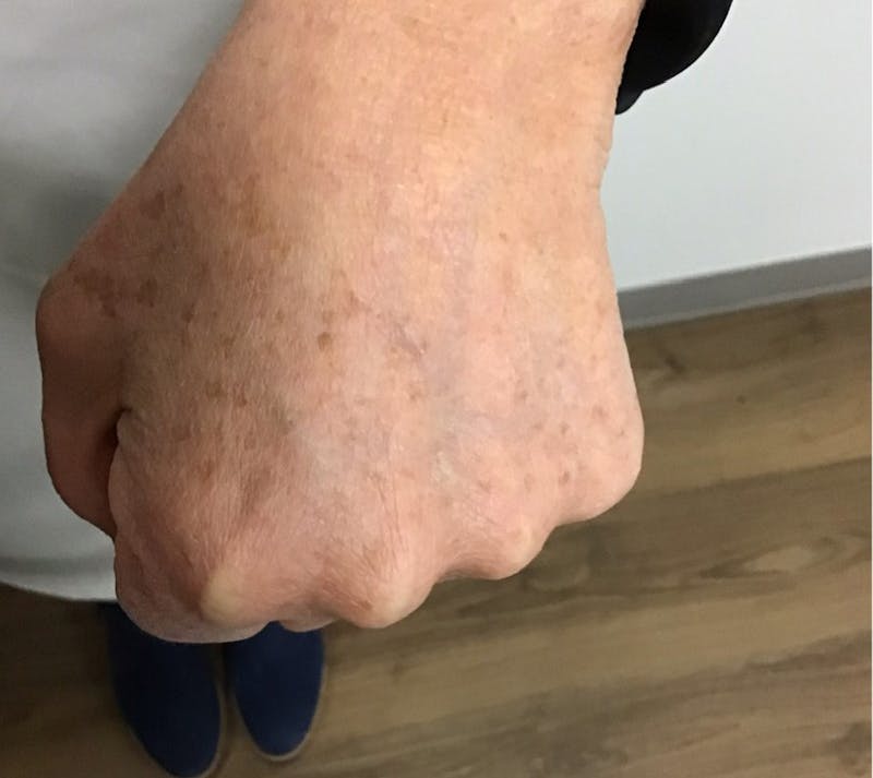 Hand Rejuvenation Before & After Gallery - Patient 55455585 - Image 3