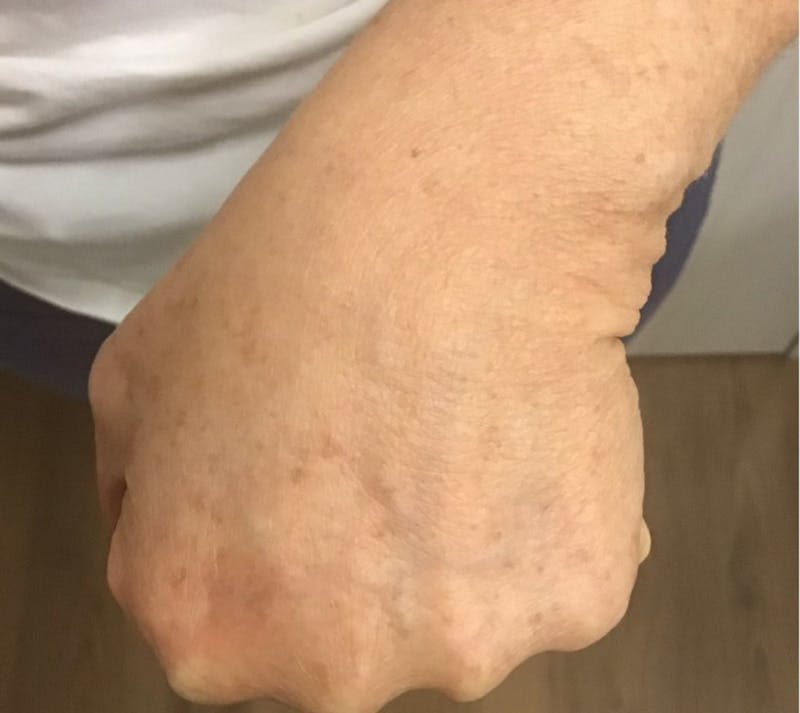 Hand Rejuvenation Before & After Gallery - Patient 55455585 - Image 4