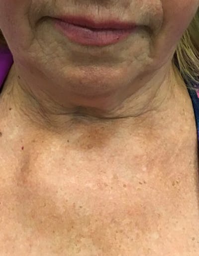 Kybella Before & After Gallery - Patient 55455595 - Image 1