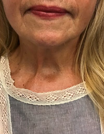 Kybella Before & After Gallery - Patient 55455595 - Image 2