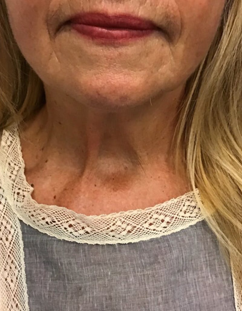 Kybella Before & After Gallery - Patient 55455595 - Image 2