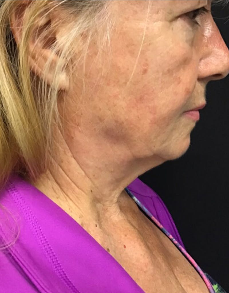 Kybella Before & After Gallery - Patient 55455595 - Image 3