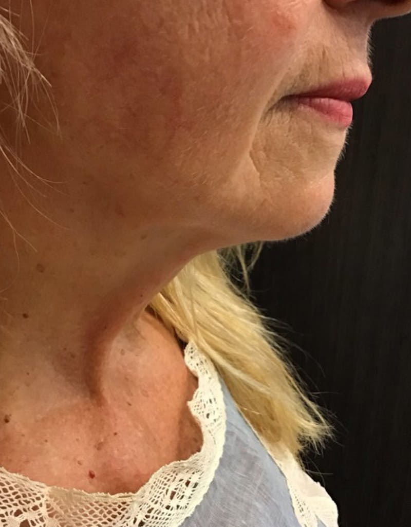 Kybella Before & After Gallery - Patient 55455595 - Image 4