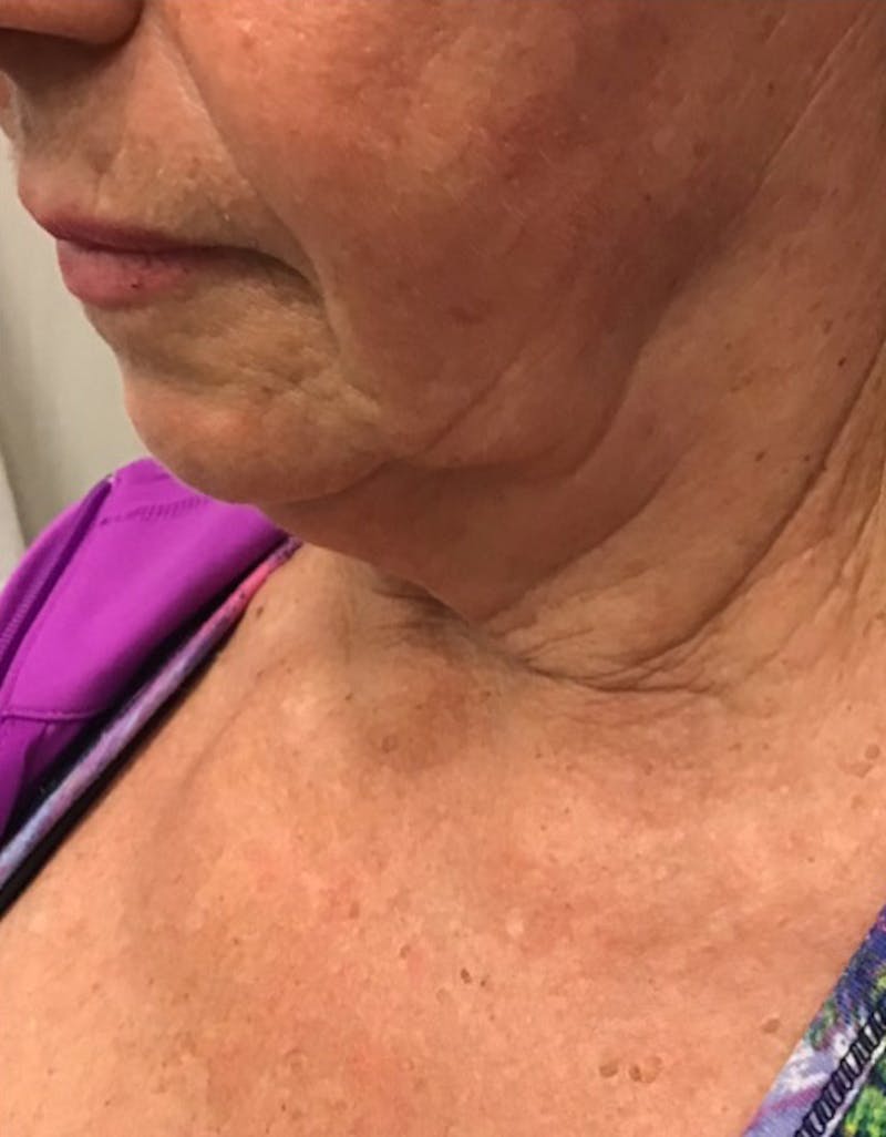 Kybella Before & After Gallery - Patient 55455595 - Image 5