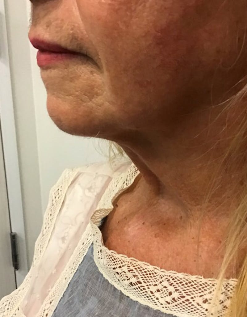 Kybella Before & After Gallery - Patient 55455595 - Image 6
