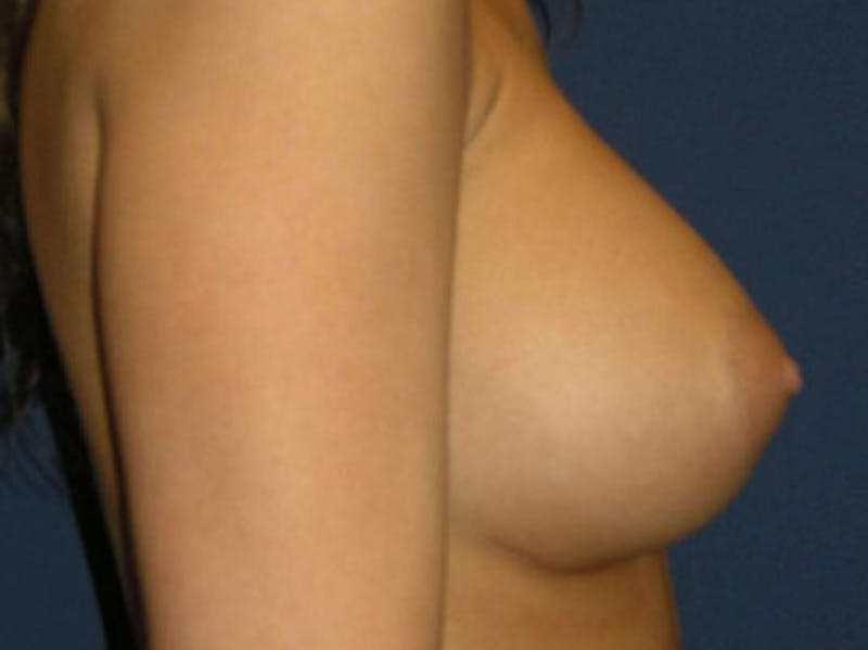 Breast Augmentation by Dr. Haydon Before & After Gallery - Patient 55455178 - Image 6