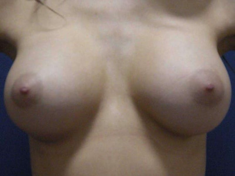 Breast Augmentation by Dr. Haydon Before & After Gallery - Patient 55455178 - Image 10