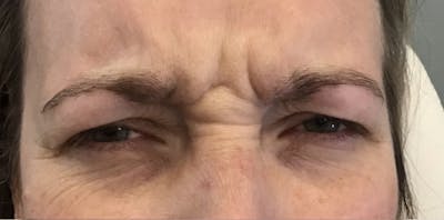 BOTOX & Dysport Before & After Gallery - Patient 55501243 - Image 1
