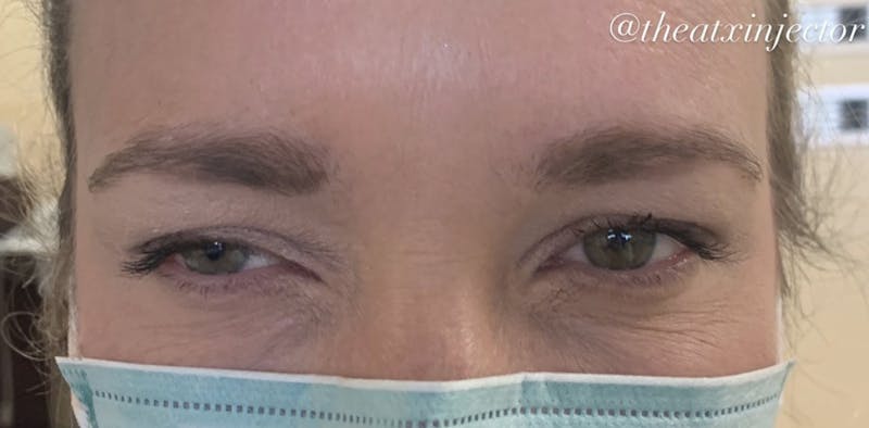 BOTOX & Dysport Before & After Gallery - Patient 55501243 - Image 2