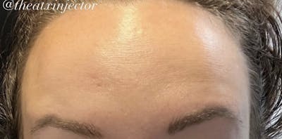 BOTOX & Dysport Before & After Gallery - Patient 55501244 - Image 2