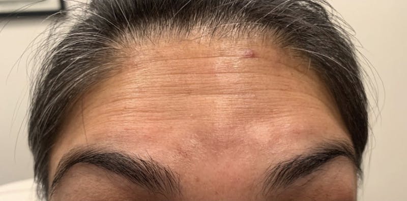 BOTOX & Dysport Before & After Gallery - Patient 55501245 - Image 1