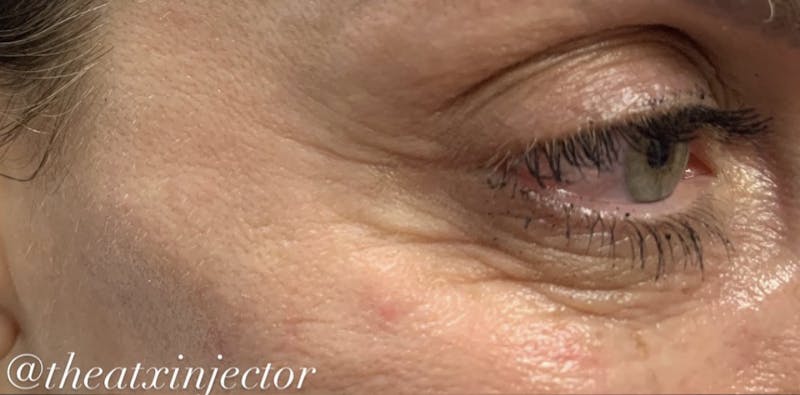 BOTOX & Dysport Before & After Gallery - Patient 55501246 - Image 1