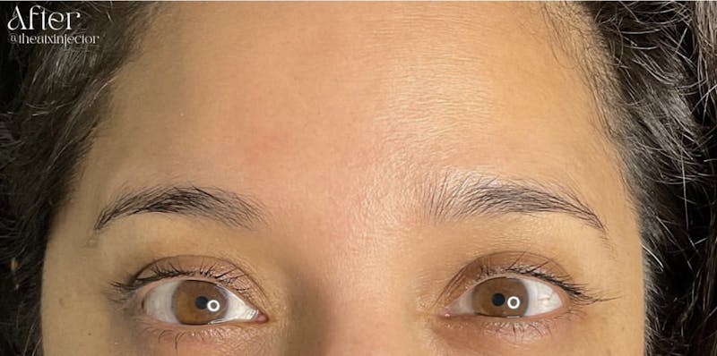 BOTOX & Dysport Before & After Gallery - Patient 55501247 - Image 2