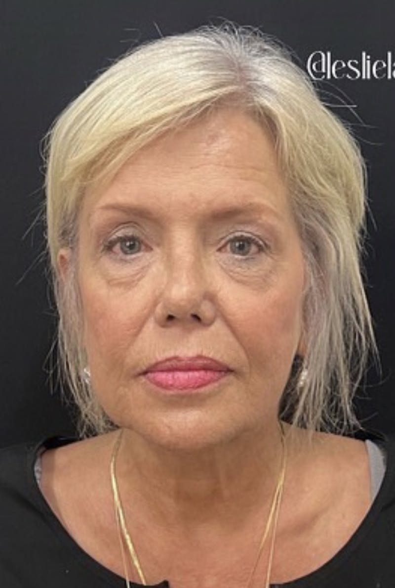 Liquid Facelift Before & After Gallery - Patient 55501260 - Image 1