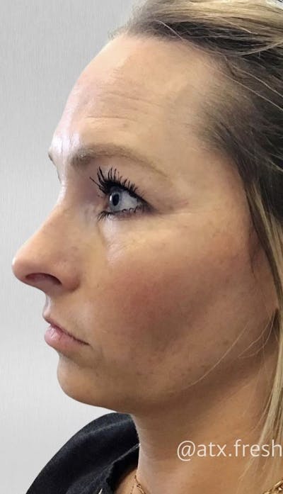 Liquid Facelift Before & After Gallery - Patient 55501261 - Image 1