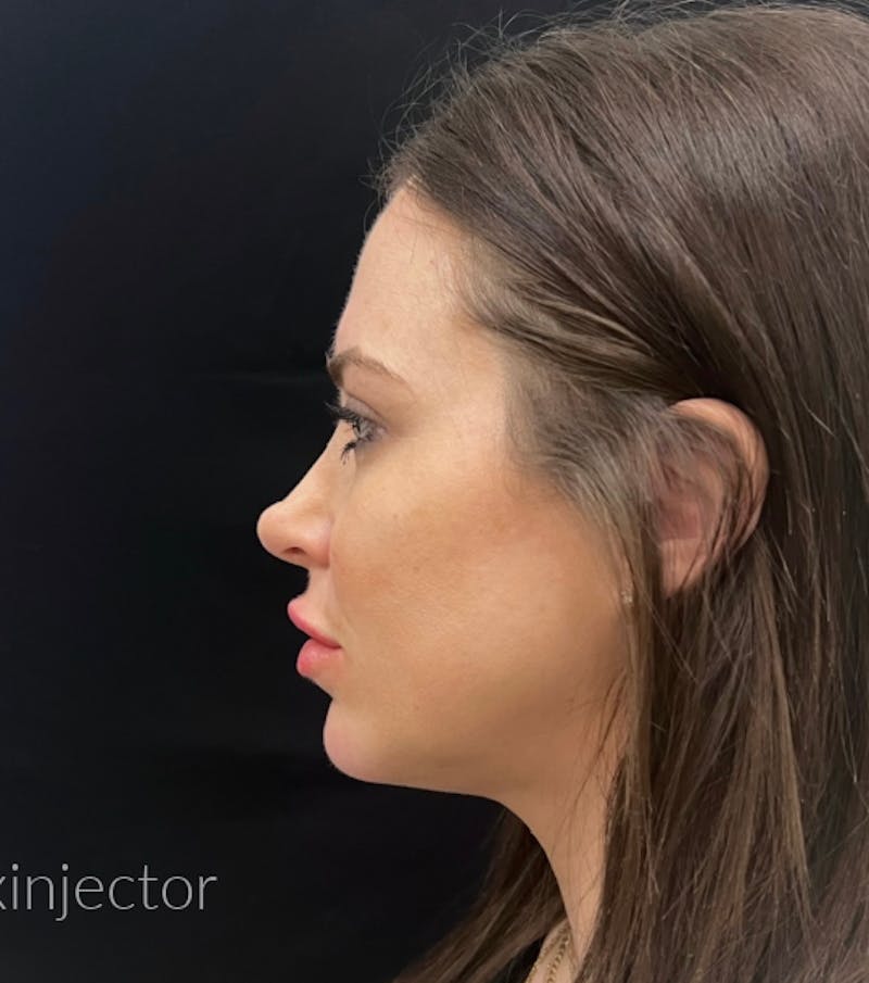 Liquid Facelift Before & After Gallery - Patient 55501262 - Image 2