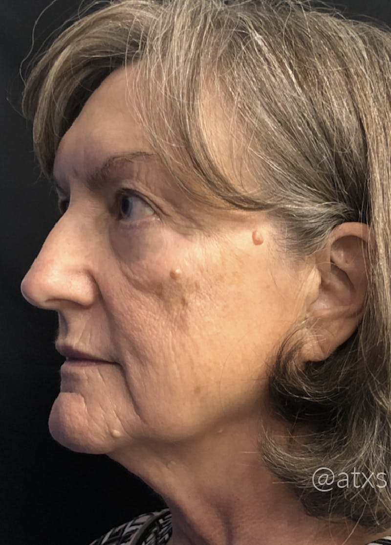 Morpheus8 Before & After Gallery - Patient 55501277 - Image 1