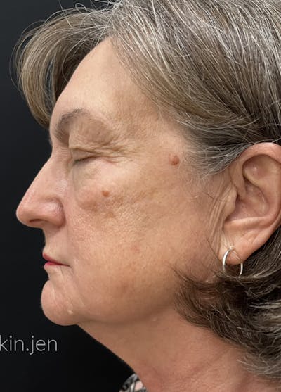 Morpheus8 Before & After Gallery - Patient 55501277 - Image 2