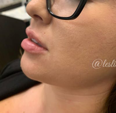 Lips Before & After Gallery - Patient 55501298 - Image 1