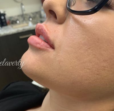 Lips Before & After Gallery - Patient 55501298 - Image 2