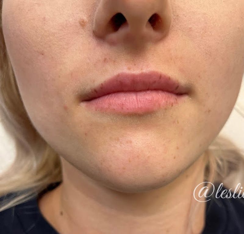 Lips Before & After Gallery - Patient 55501299 - Image 1