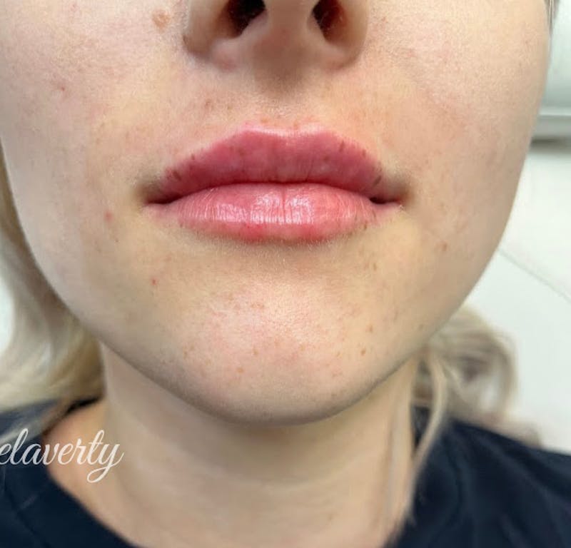 Lips Before & After Gallery - Patient 55501299 - Image 2