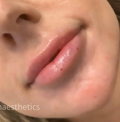 Lips Before & After Gallery - Patient 55501300 - Image 2