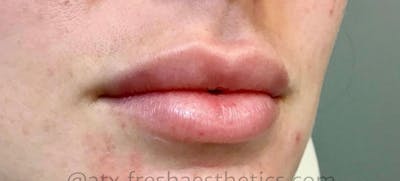 Lips Before & After Gallery - Patient 55501301 - Image 1
