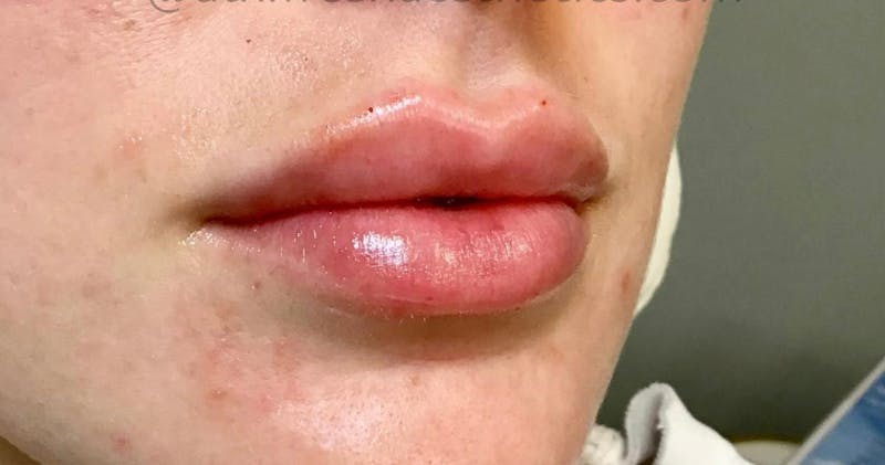 Lips Before & After Gallery - Patient 55501301 - Image 2