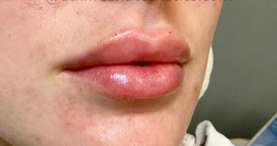 Lips Before & After Gallery - Patient 55501301 - Image 2