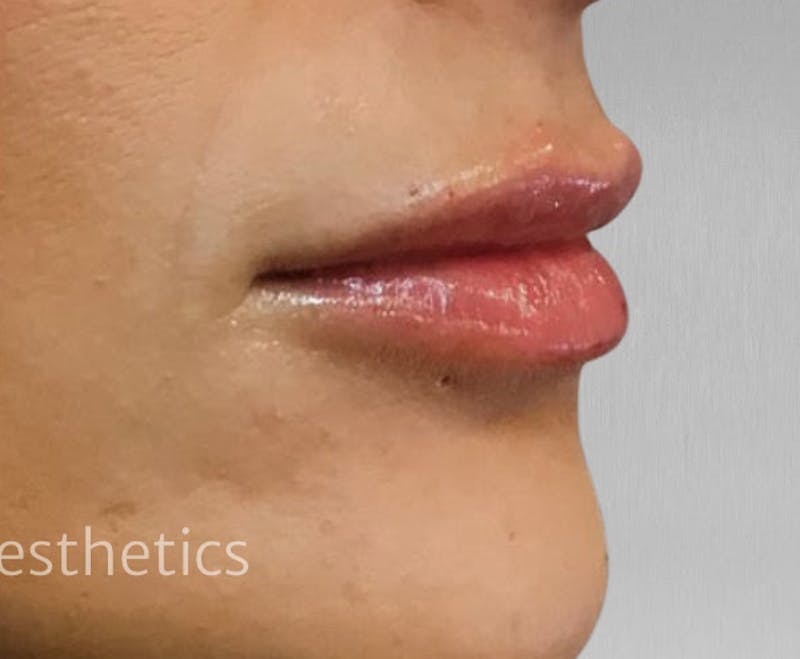 Lips Before & After Gallery - Patient 55501302 - Image 2
