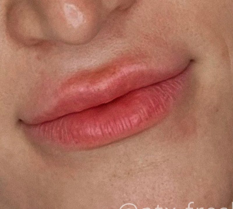 Lips Before & After Gallery - Patient 55501303 - Image 1