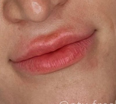 Lips Before & After Gallery - Patient 55501303 - Image 1