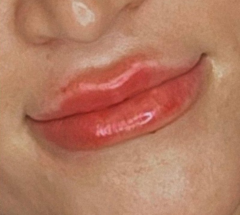 Lips Before & After Gallery - Patient 55501303 - Image 2