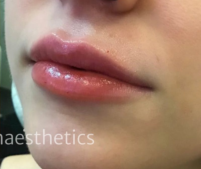 Lips Before & After Gallery - Patient 55501358 - Image 2