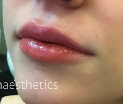 Lips Before & After Gallery - Patient 55501358 - Image 2