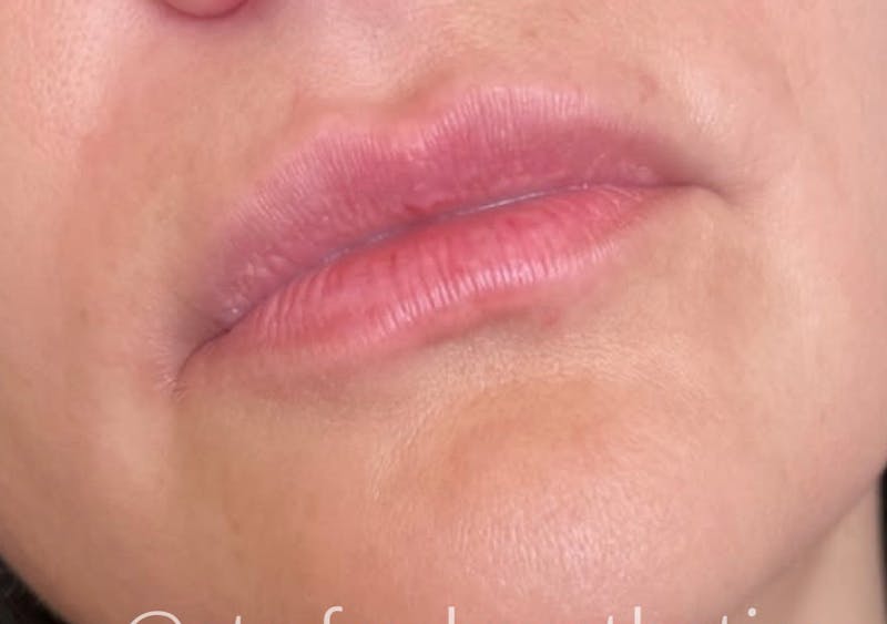 Lips Before & After Gallery - Patient 55501376 - Image 1