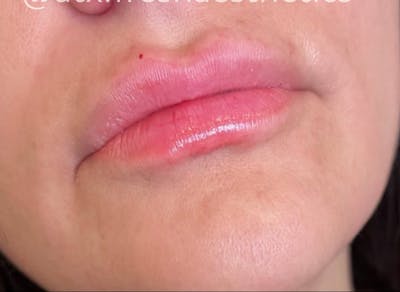 Lips Before & After Gallery - Patient 55501376 - Image 2