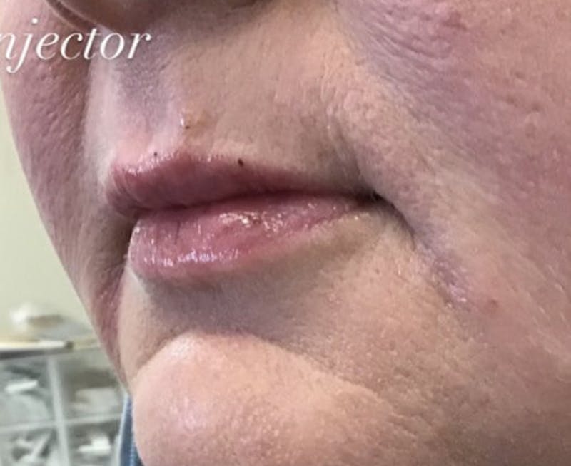 Lips Before & After Gallery - Patient 55501377 - Image 2