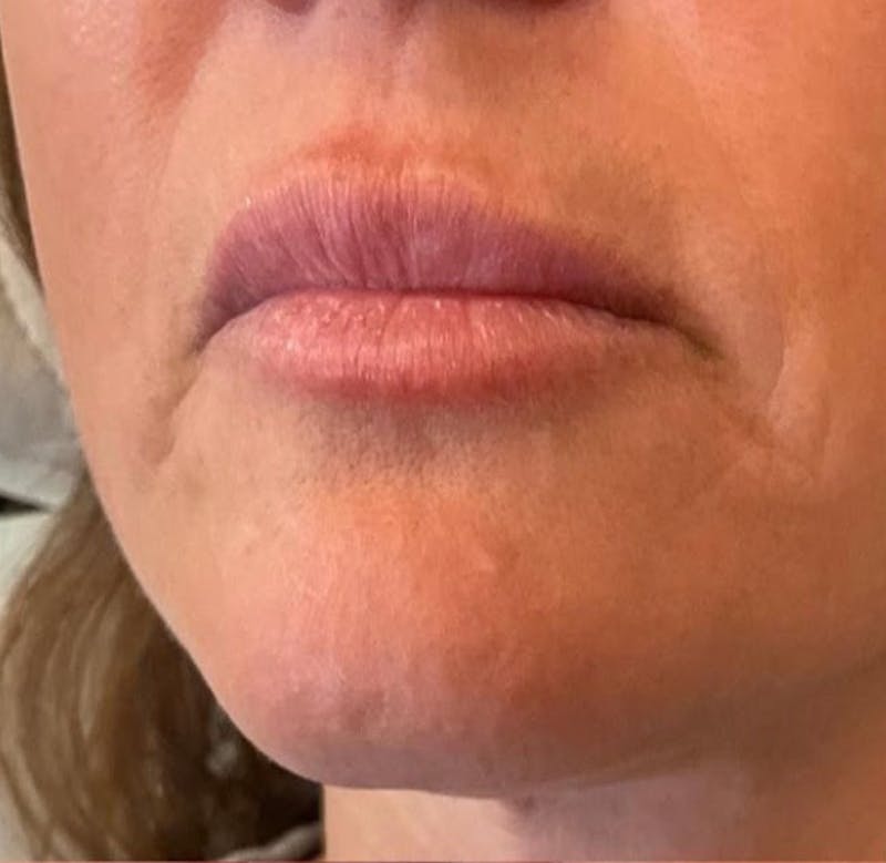 Lips Before & After Gallery - Patient 55501378 - Image 1