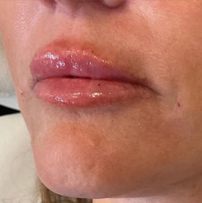 Lips Before & After Gallery - Patient 55501378 - Image 2