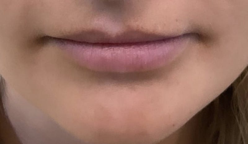 Lips Before & After Gallery - Patient 55501383 - Image 1