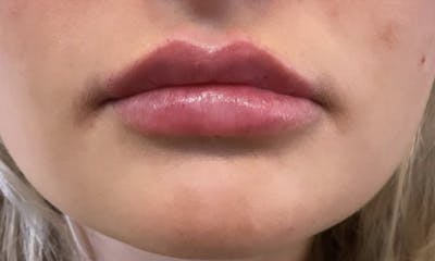 Lips Before & After Gallery - Patient 55501383 - Image 2