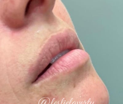 Lips Before & After Gallery - Patient 55501384 - Image 1